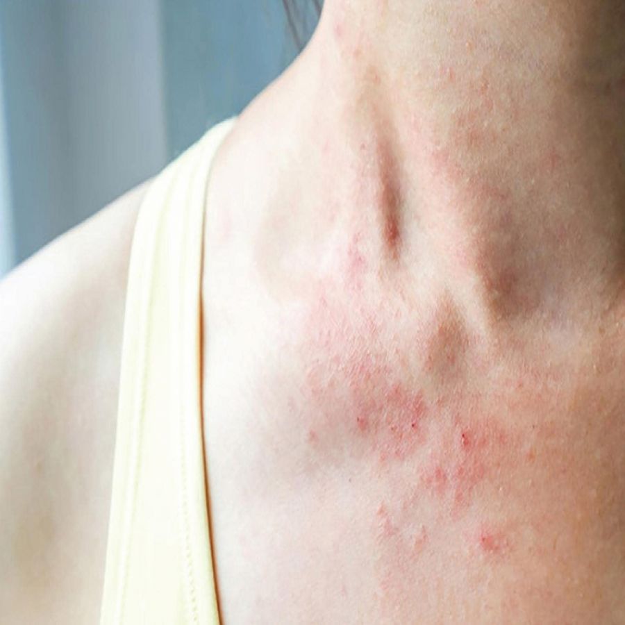 Vì sao chúng ta bị dị ứng thời tiết?